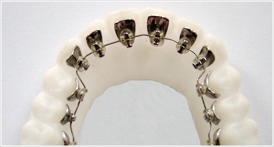 牙齒矯正改變臉型